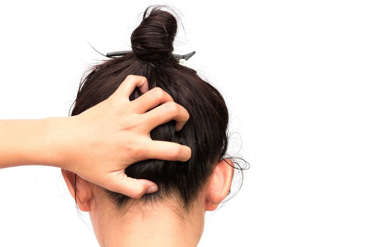 Woman scratching itchy scalp from the rear