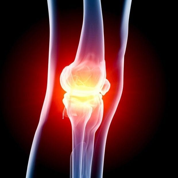 Weight loss key in reducing osteoarthritis symptoms, researchers say 