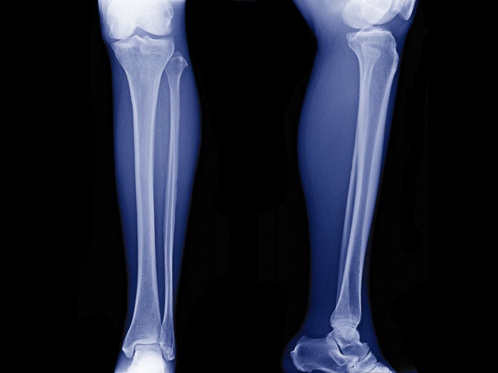 Bone Health: Many people need bone support. Will more turn to dietary supplements?